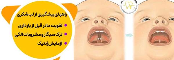 عکس بچه ی لب شکری