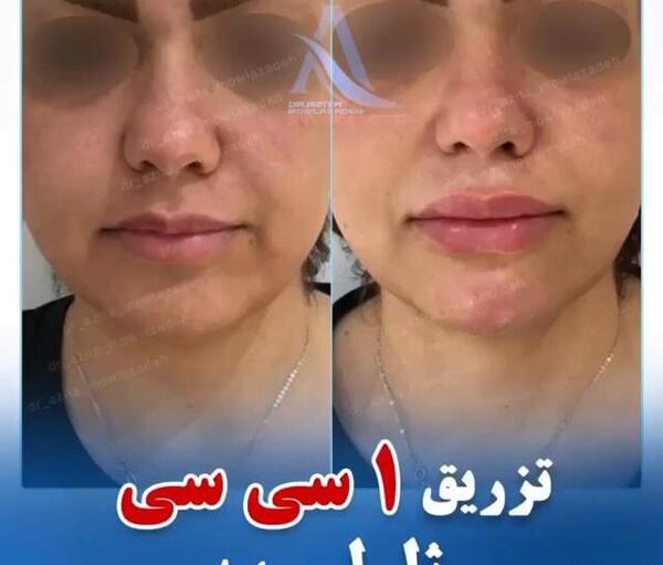 عکس یه سیسی ژل لب