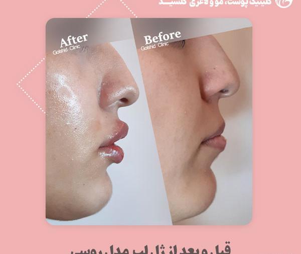 عکس یه سیسی ژل لب