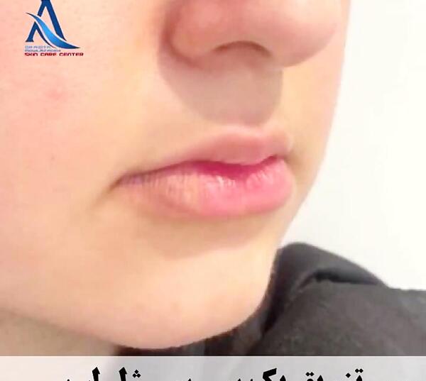 عکس یه سیسی ژل لب