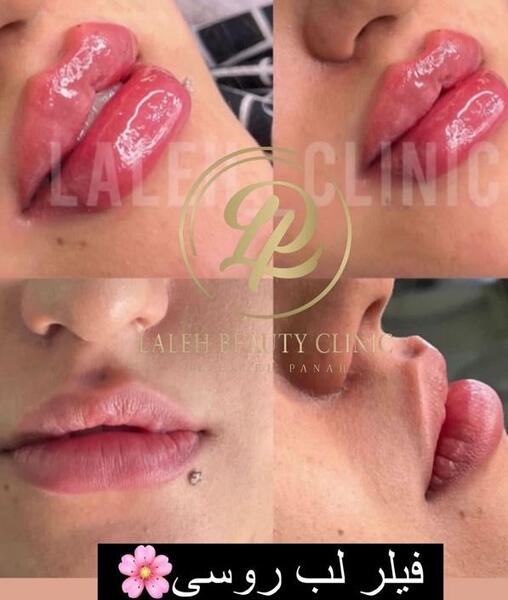 عکس یه سیسی ژل لب