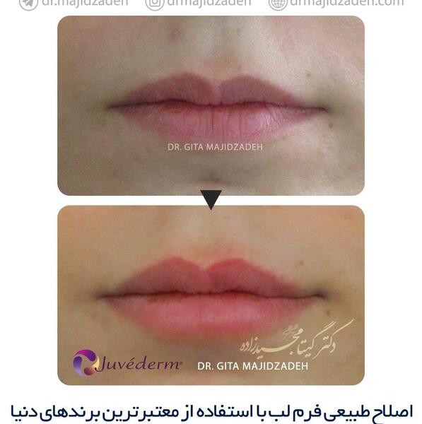 عکس یه سیسی ژل لب