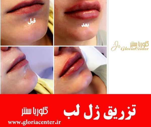عکس یه سیسی ژل لب