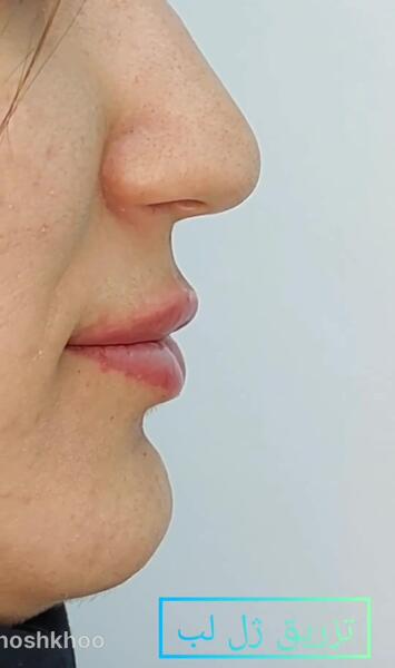 عکس یه سیسی ژل لب