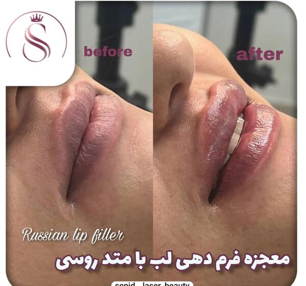عکس یه سیسی ژل لب