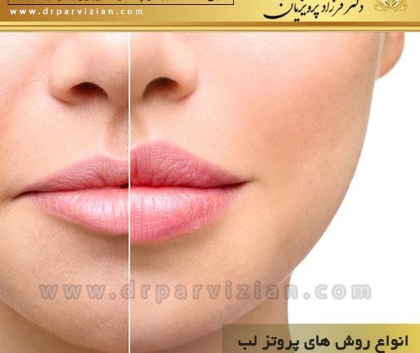 عکس لب های پروتز