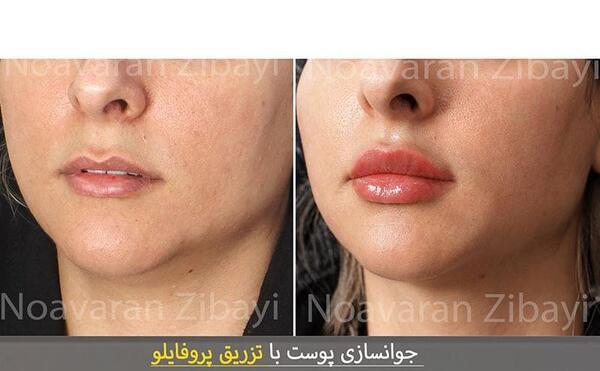 عکس لب های پروتز