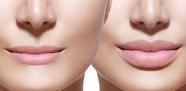 عکس لب های پروتز