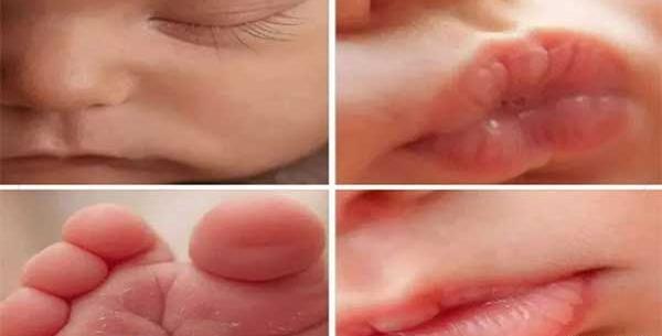 عکس تاول لب نوزاد