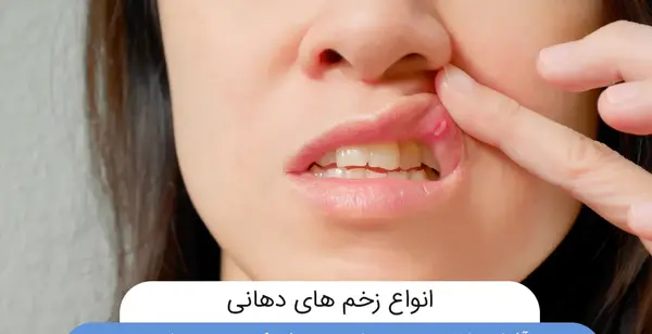 عکس تاول لب نوزاد