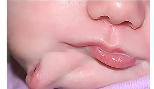 عکس لب و دهان نوزاد