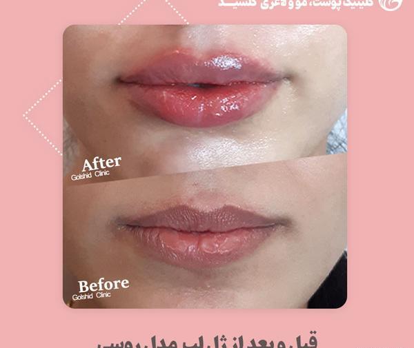 عکس تزریق لب مدل روسی