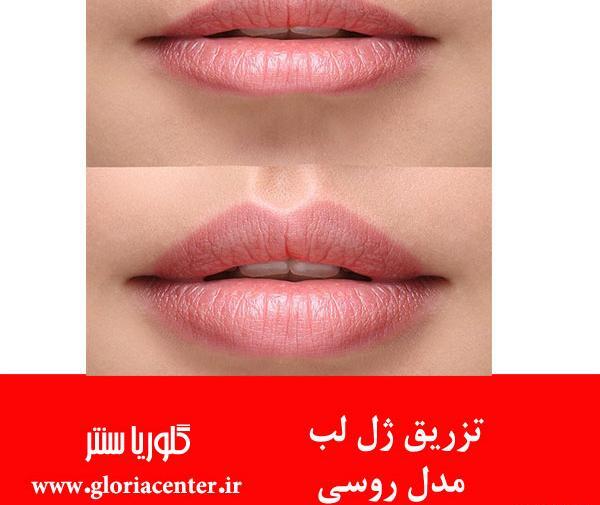عکس تزریق لب مدل روسی