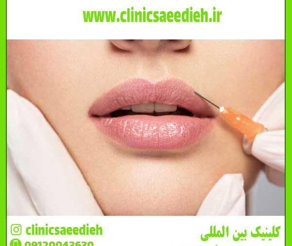 عکس تزریق لب مدل روسی