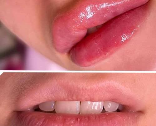 عکس تزریق لب مدل روسی