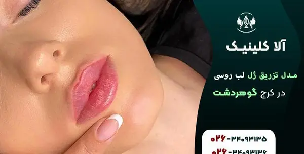 عکس تزریق لب مدل روسی
