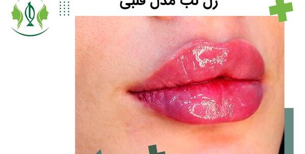 عکس ژل لب معمولی
