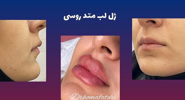 عکس ژل لب معمولی