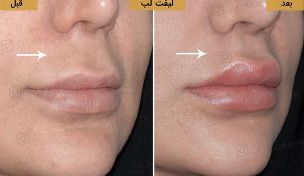 عکس لیفت سانترال لب