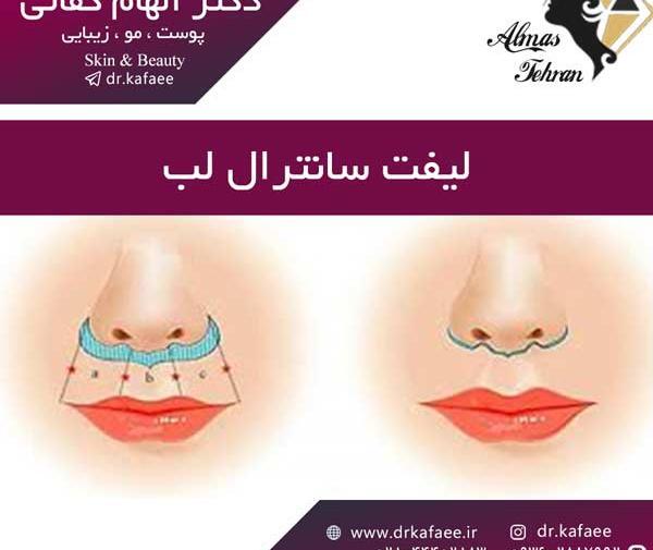 عکس لیفت سانترال لب