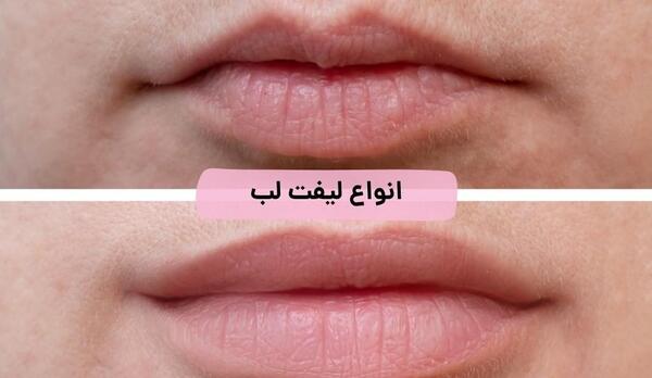 عکس لیفت سانترال لب