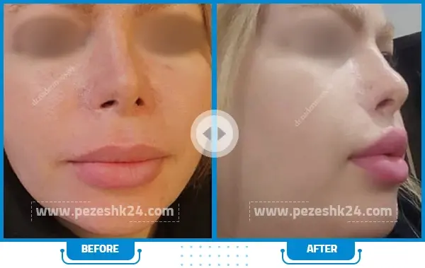 عکس لیفت سانترال لب