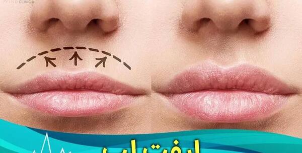 عکس لیفت سانترال لب