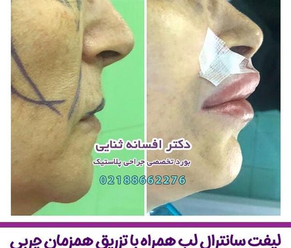 عکس لیفت سانترال لب