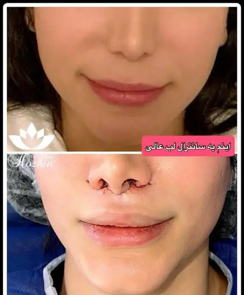 عکس لیفت سانترال لب
