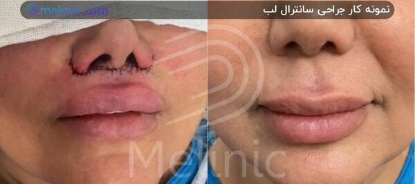 عکس لیفت سانترال لب