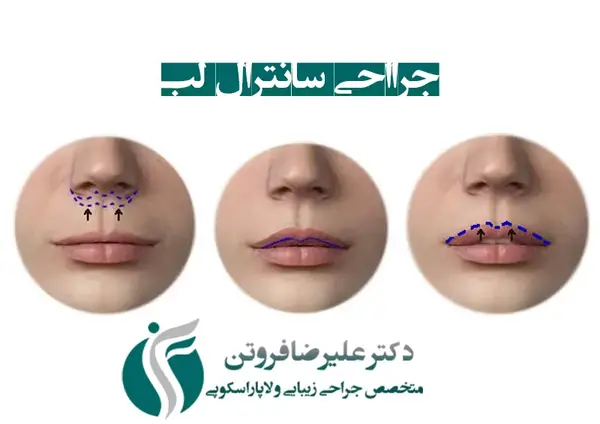 عکس لیفت سانترال لب