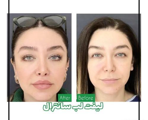عکس لیفت سانترال لب