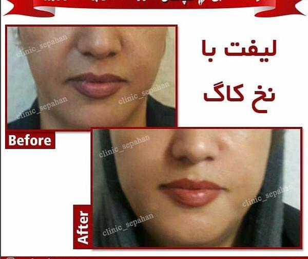عکس قبل و بعد لیفت لب