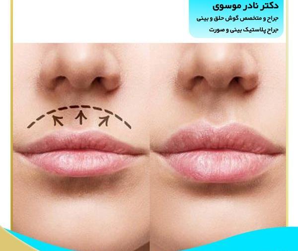 عکس قبل و بعد لیفت لب