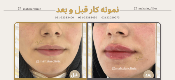 عکس قبل و بعد لیفت لب
