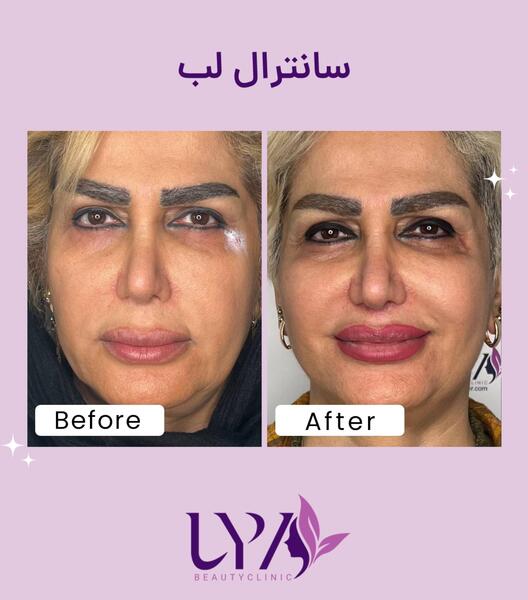 عکس قبل و بعد لیفت لب