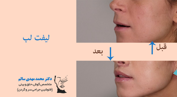 عکس قبل و بعد لیفت لب