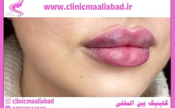 عکس ژل لب قلوه ای