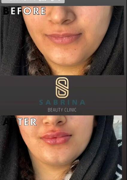 عکس ژل لب قلوه ای