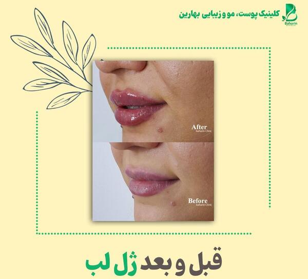 عکس ژل لب مدل قلوه ای