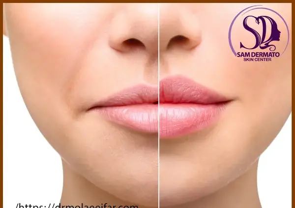 عکس ژل لب مدل قلوه ای
