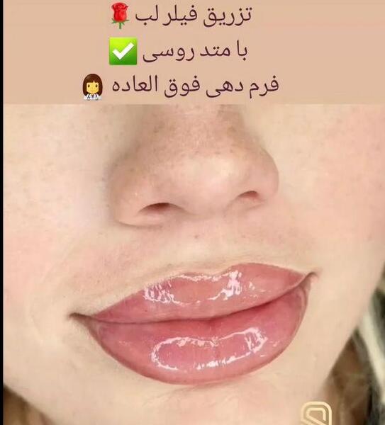 عکس ژل لب مدل قلوه ای