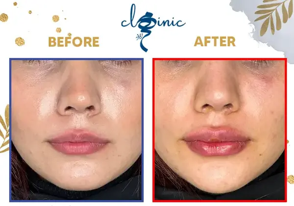 عکس ژل لب مدل قلوه ای