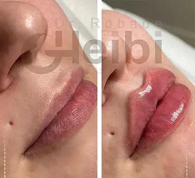 عکس ژل لب مدل قلوه ای