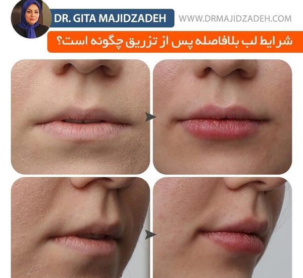 عکس ژل لب فرانسوی
