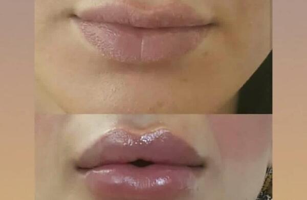 عکس ژل لب فرانسوی