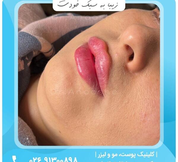 عکس ژل لب فرانسوی