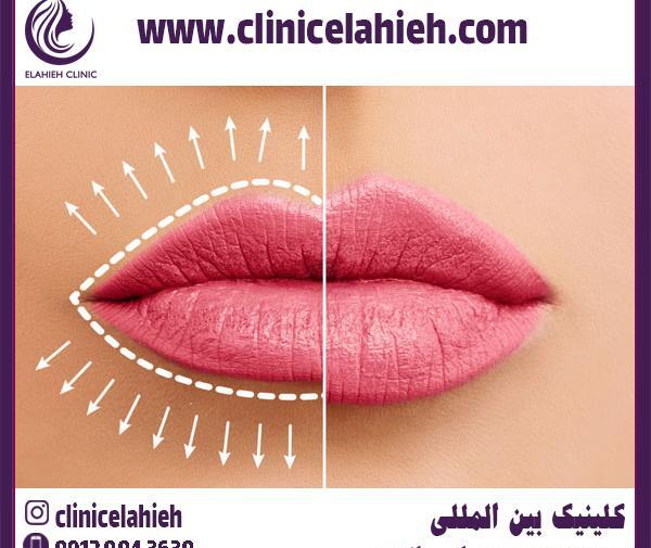 عکس لب ژل زده عروسکی