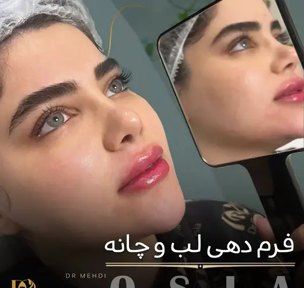 عکس لب ژل زده عروسکی