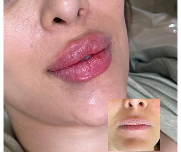 عکس لب ژل زده عروسکی